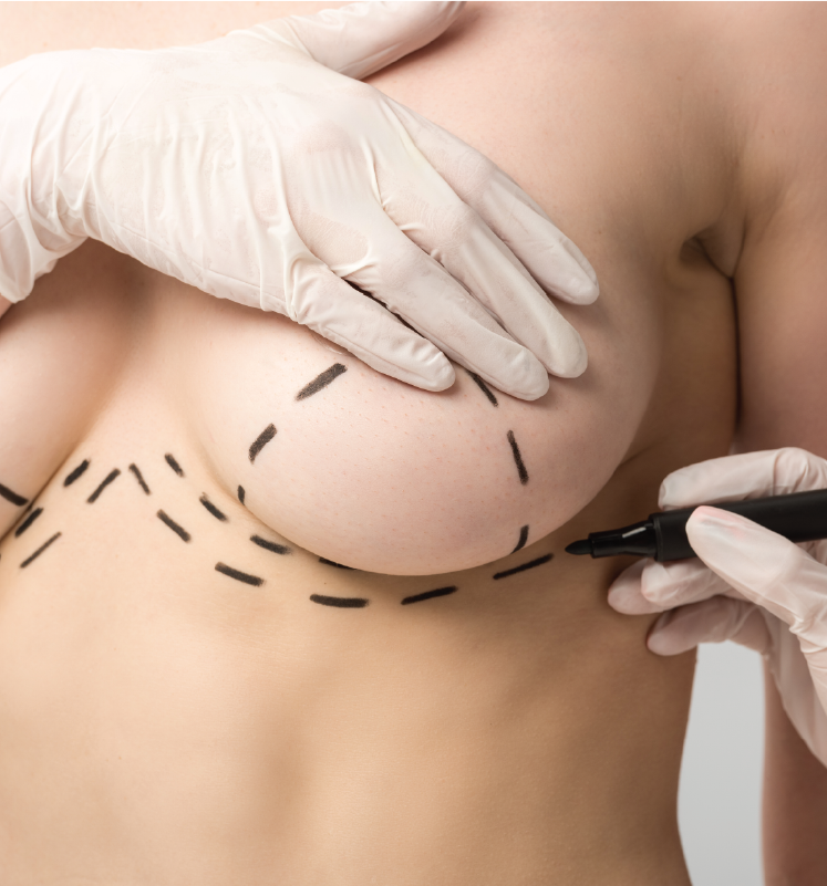breast-lift-1