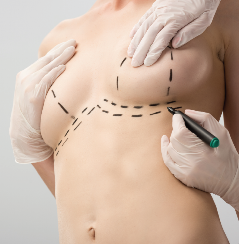 breast-lift-4