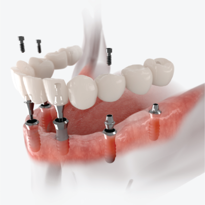 dental-implant-1 dental-implant-1