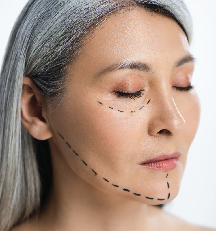 facelift-1