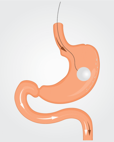 gastric-balloon-1 gastric-balloon-1