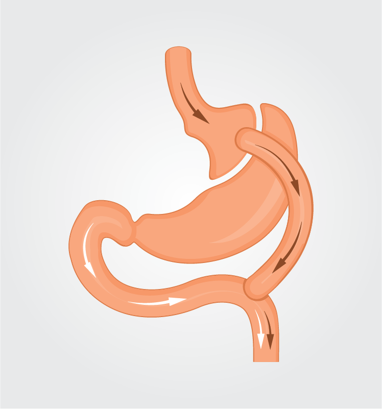 gastric-bypass-1