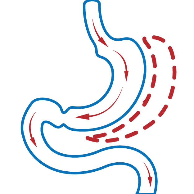 gastric sleev
