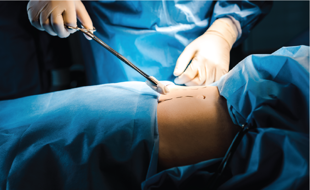 liposuction-3