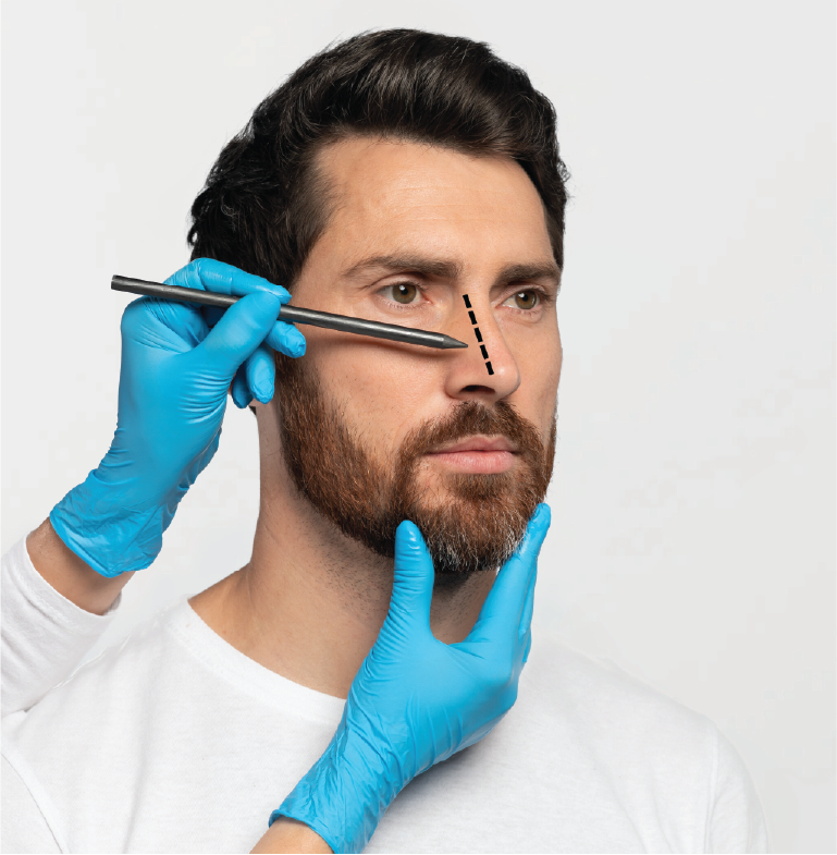 rhinoplasty-4