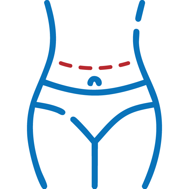 tummy tuck